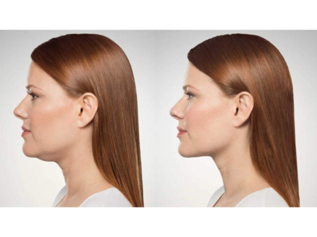 Get Rid of Double Chin